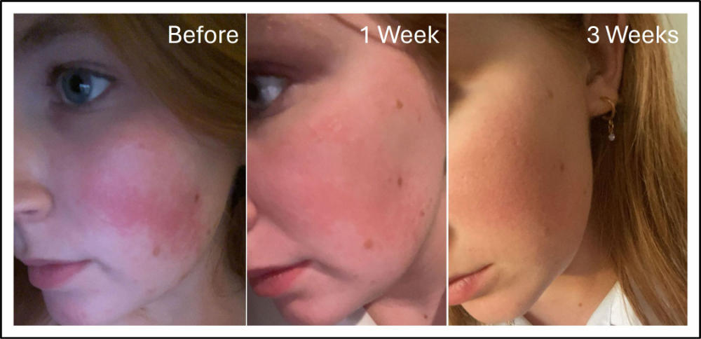 Rosacea